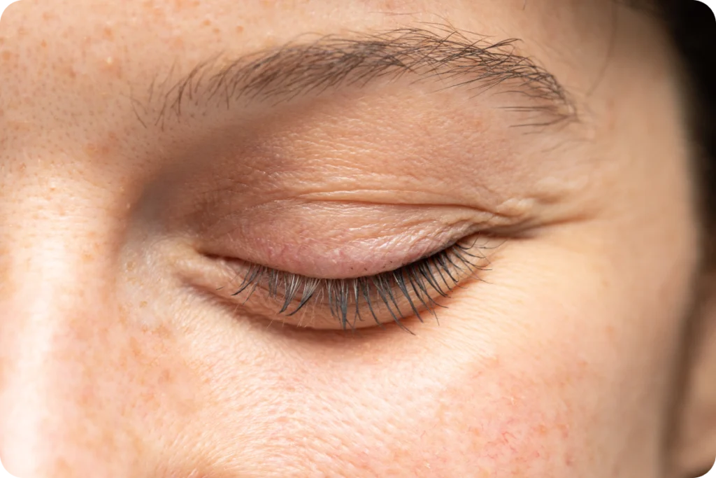 Consultation pour une blépharoplastie à Écully, à Lyon