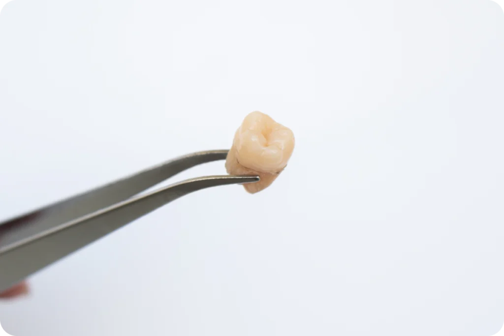 Rendez-vous pour l'extraction des dents de sagesse à Écully