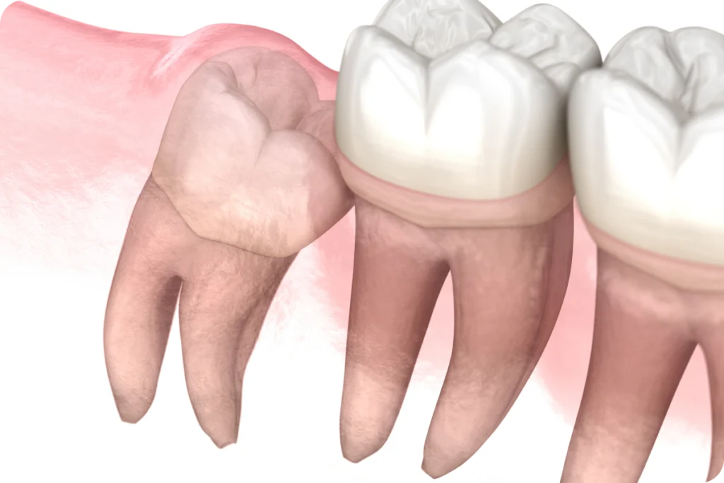 Extraction des dents de sagesse à Lyon