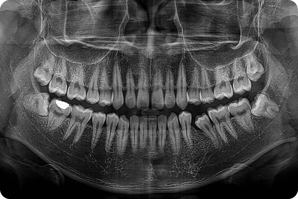 Extraction des dents de sagesse à Lyon