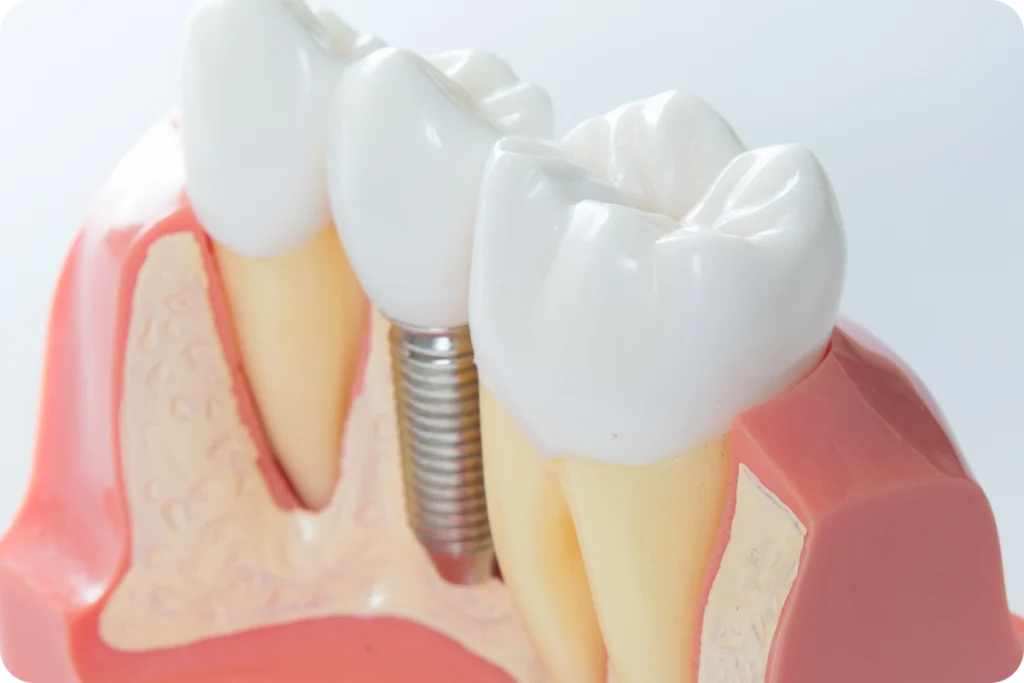 Implants dentaires à Lyon