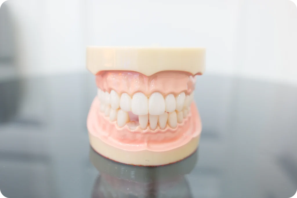 Rendez-vous pour la pose d'implants dentaires à Lyon